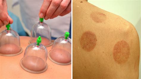 cupping aftermath|More.